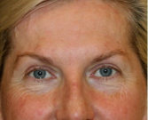 Feel Beautiful - Blepharoplasty Upper Browlift 107 - After Photo